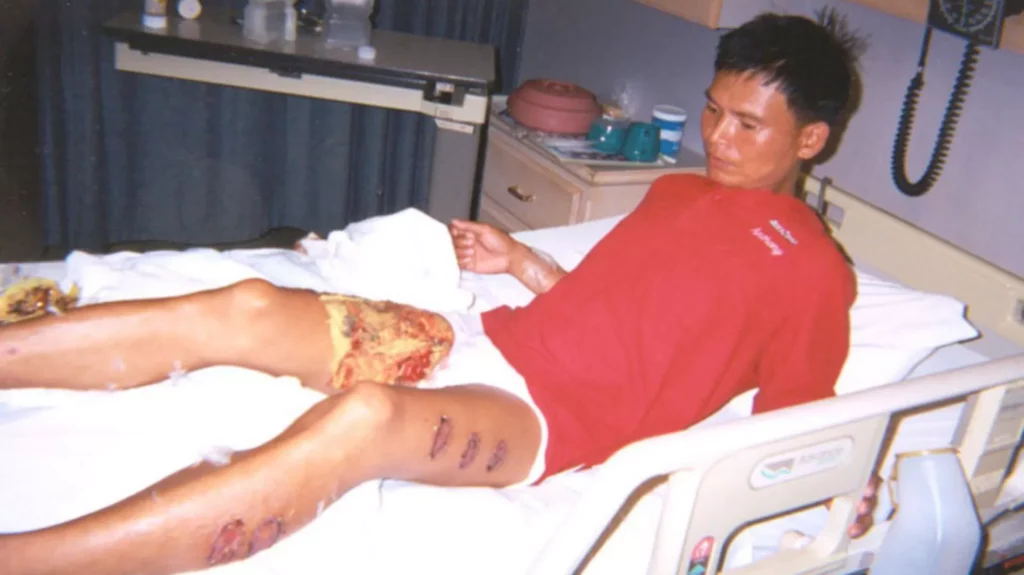 Ảnh chụp ông Tân tại một bệnh viện ở Houston, năm 2001. Học Viên Pháp Luân Công bị tra tấn bằng thanh sắt nung nóng gây bỏng nặng