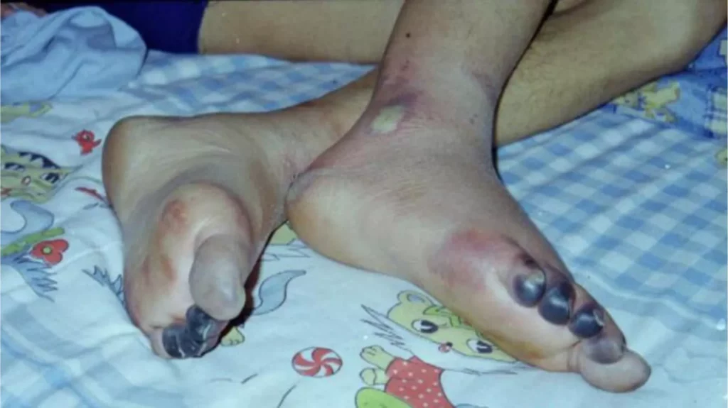 Tra tấn học viên Pháp Luân Công bằng phương pháp đóng băng khiến chân bị bỏng lạnh